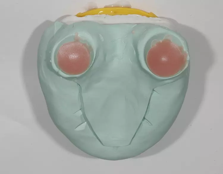 Abb. 115: Aesthetic Blue Autopolymerisat eingebracht.