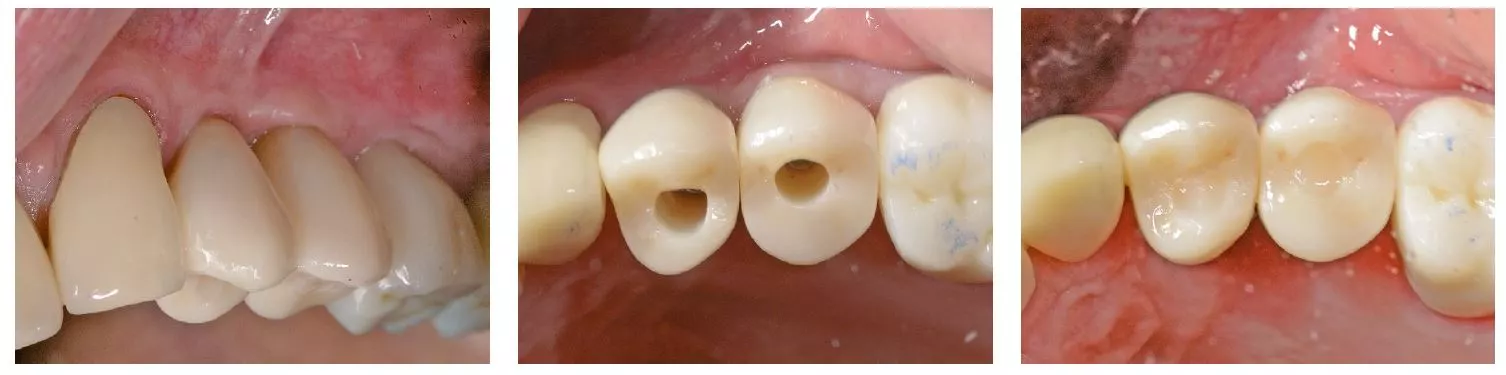 Abb. 11: Die definitiven implantatgetragenen Kronen unmittelbar nach dem Verschrauben im Mund des Patienten.