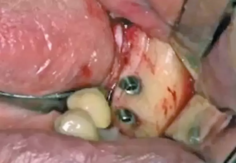 Abb. 11: Inserierte Implantate - abgeschrägte Kontur der Schulter bukkal in Relation zum Knochenniveau.