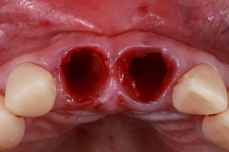 Abb. 11: Extraktionsalveolen mit erhaltener knöcherner und gingivaler
Architektur.