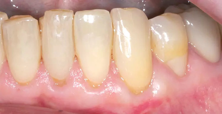 Abb. 11: Resultat zwei Monate post OP zeigt stabile Schleimhautverhältnisse an 33 mit extendiertem Saum an keratinisierter Gingiva.