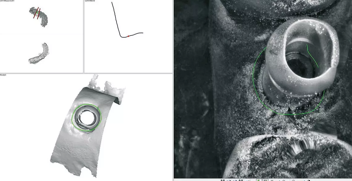 Abb. 11: Darstellung des Scanpfostens in der Intraoralscanner-Software mit definierter Implantatposition und Indexierung für die Orientierung des Abutments.