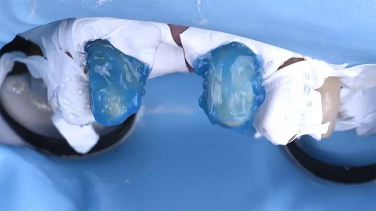 Abb. 11: Konditionierung der Pfeiler, Isolierung der Nachbarzähne mit der Teflon-Tape-Technique.