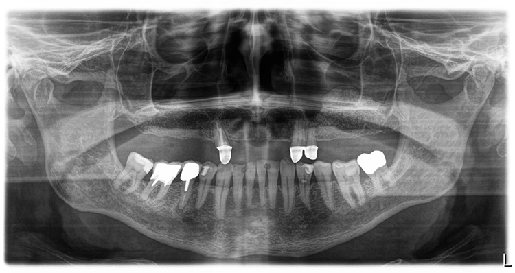 Abb. 11: Stabile Knochenstrukturen nach der achtmonatigen Heilphase.