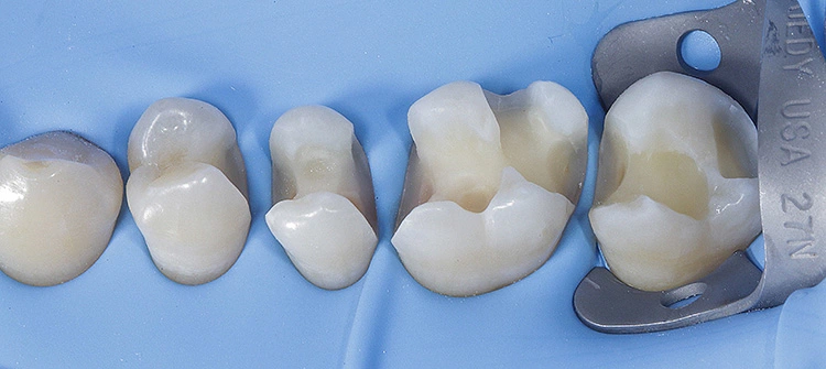 Abb. 11: Zustand nach kinetischer Kavitätenpräparation (mit Al2O3) und Air-Polishing (mit Glycinpulver), Ansicht von vestibulär.