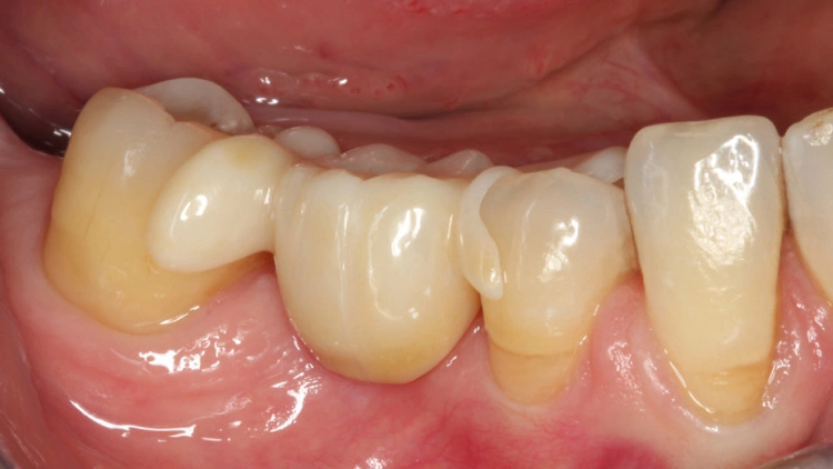 Abb. 9: Der Molar 46 aus Zirkonoxid wurde mittig geteilt. Die 2 Flügel wurden lateral mit Zementierungsschlüssel adhäsiv befestigt.