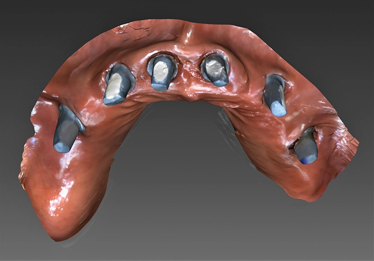 Abb. 11: Eingescannte Abutments mit entsprechendem Emergenzprofil.