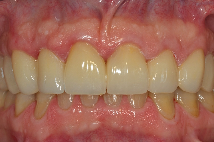 Abb. 11: Intraorales Behandlungsergebnis unmittelbar nach Eingliederung.