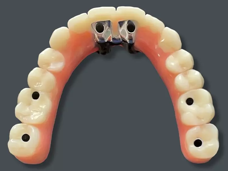 Abb. 9: Definitive Brücke zur Befestigung auf 4 Implantaten mit Erweiterung um
2 stützende Implantate.