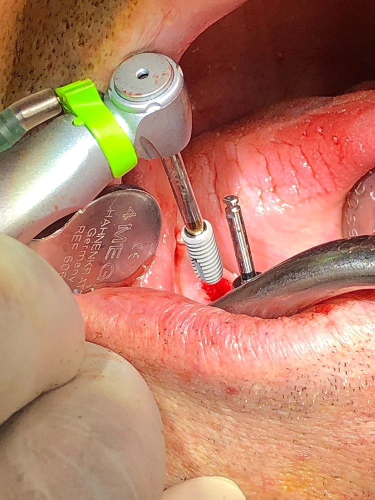 Abb. 11: Maschinelles Eindrehen des copaSKY Implantats.