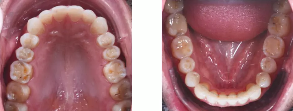 Abb. 11: Behandlungsphase 1 von 2: nach Abschluss mit Invisalign®, Okklusalansicht.