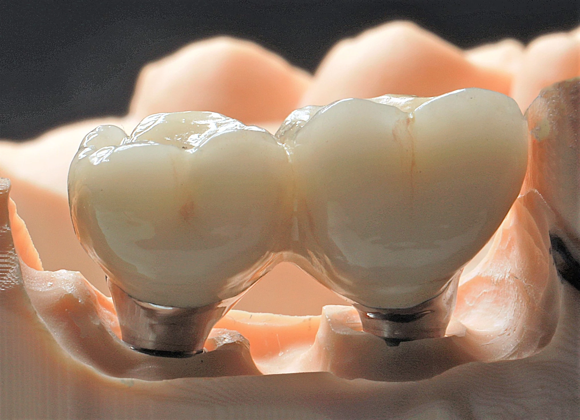 Implantatgetragene, verblockt-verschraubte Kronen auf emergenzprofilierten Abutments (Atlantis, Dentsply Sirona), regio 26-27, nach klinischer Weichgewebsausformung (Modellansicht).