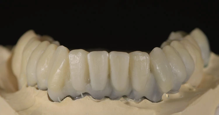 Abb. 11a: Wax-up auf dem Metallgerüst vor dem Einbetten.