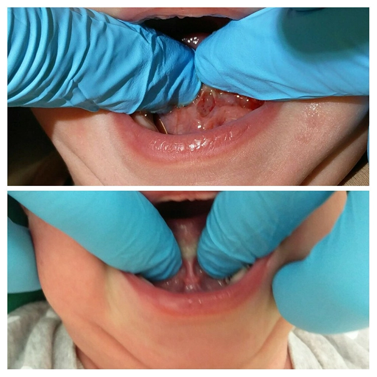Abb. 12: Bild oben: Zungenband nach vollständiger Trennung. Bild unten: Zungenband nach unvollständiger Trennung alio loco.
