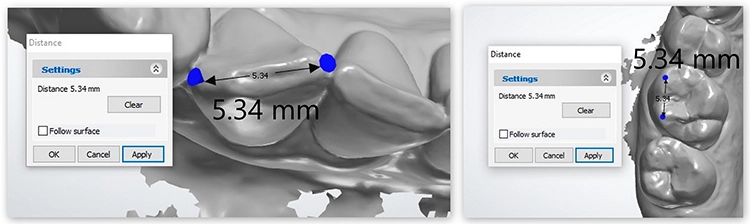 Abb. 12 a, b: Patientenbeispiel Intraoralscan. Zusammenhang zwischen der unteren 2. Inzisivenbreite und dem bukkalen Höckerspitzenabstand der 1. oberen Molaren.