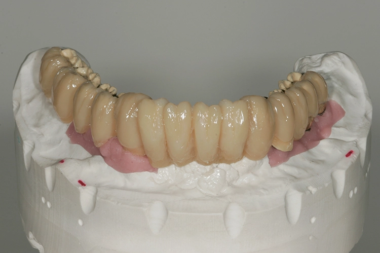 Abb. 121: Dentinschichtung vestibulär.