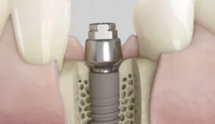 Acuris basiert auf einem konometrischen Konzept, das im abschließenden prothetischen Schritt der Implantatbehandlung die Befestigung der Krone und der Kappe auf dem Abutment durch Friktion ermöglicht – ohne Schrauben und ohne Zement.