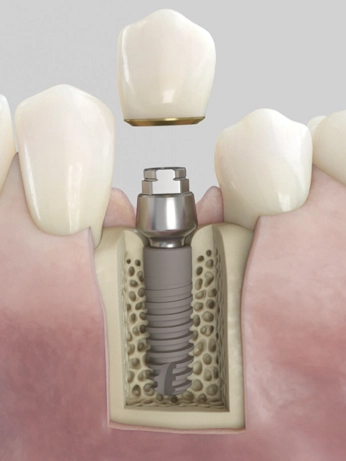 Acuris basiert auf einem konometrischen Konzept, das im abschließenden prothetischen Schritt der Implantatbehandlung die Befestigung der Krone und der Kappe auf dem Abutment durch Friktion ermöglicht – ohne Schrauben und ohne Zement.