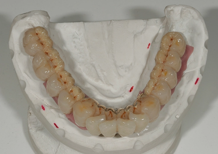 Abb. 126: Auftrag der labialen/bukkalen Schneidemassen.