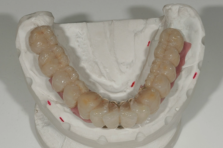 Abb. 128: Komplettieren der Kauflächen mit Schneidemasse.