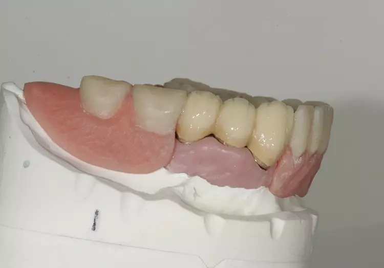 Abb. 129: Hals- und Dentinmasse bukkal.