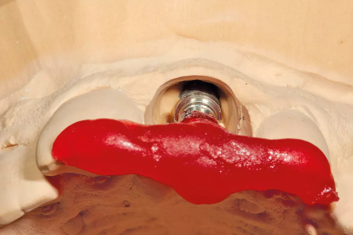 Abb. 12a: Implantatschlüsselmodell.