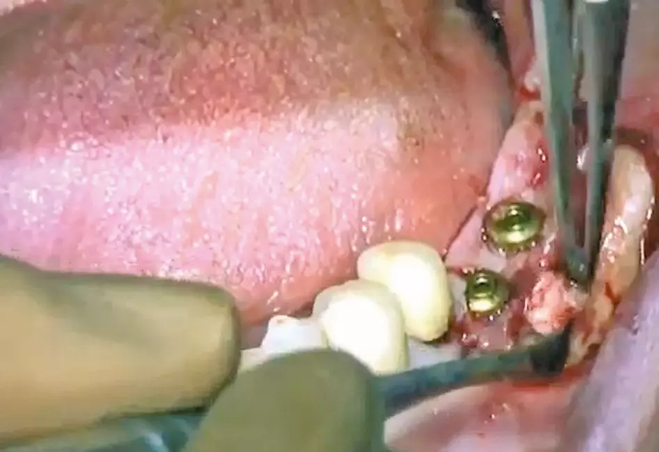 Abb. 12: Augmentation mit Eigenknochen nach dem Aufsetzen der Gingivaformer.