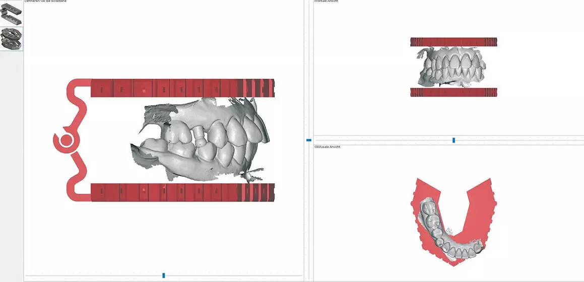 Abb. 12: Ansicht der digitalen Modelle im Schlussbiss, der Okklusionsebene und von frontal (Scanner-Software).
