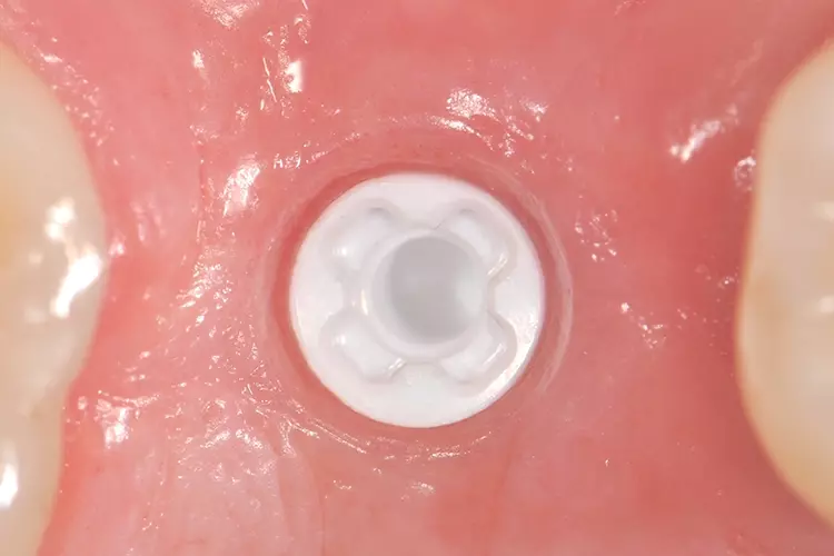 Abb. 12: Keramisches Implantat.