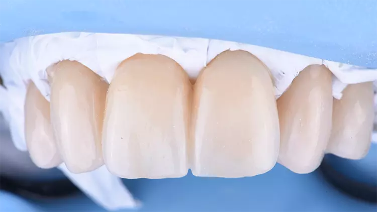 Abb. 12: Eingesetzte Restauration mit der Teflon-Tape-Technique.