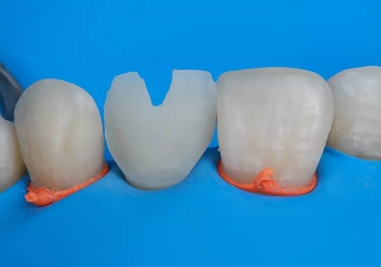 Abb. 12: Vorbereitung für die Schichtung des Komposit-Veneers unter absoluter Trockenlegung mit
Kofferdam.
