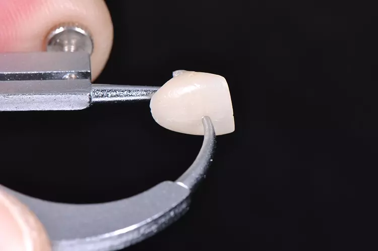 Abb. 12: Inspektion der provisorischen Krone mit einem Tasterzirkel zur
Kontrolle des materialspezifischen Substanzabtrags.