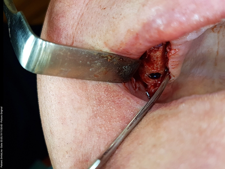 Abb. 12: Darstellung der Implantatsitus in regiones 17, 15 bis 14, 12, 22 und 25 bis 27 mit knöchernen Defekten im bukkalen und frontalen Bereich.