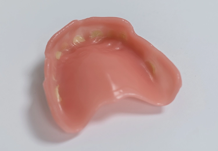 Abb. 12: Gelöste Prothese.