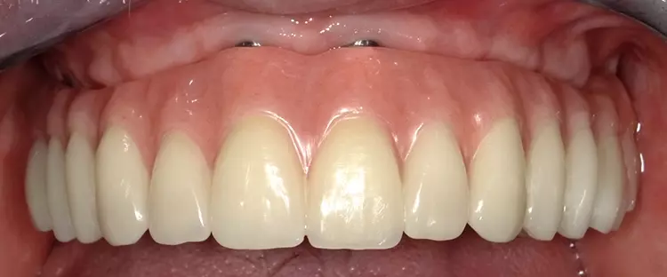 Abb. 10: Definitiver Zahnersatz in situ.