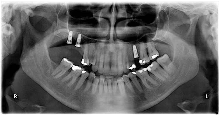 Abb. 12: Röntgenkontrollaufnahme nach dem Eingriff mit plangemäß inserierten Implantaten.