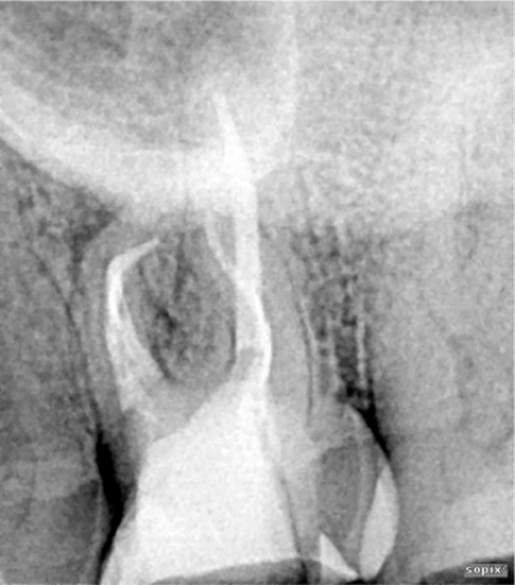 Abb. 13: OK-Molar mit großem Krümmungswinkel und kleinem Radius mesial.