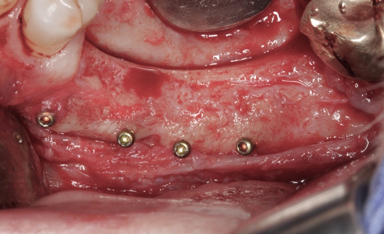 Abb. 12: Der gut revaskularisierte Knochen im Unterkiefer links. Keine erkennbare Resorption im Bereich der Fixationsschrauben.