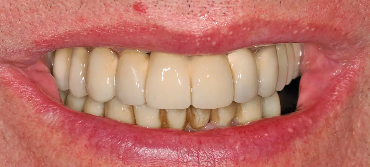 Abb. 12c: Lachbild (das untere Langzeitprovisorium ist durch die 14-tägige CHX-Spülung verfärbt.