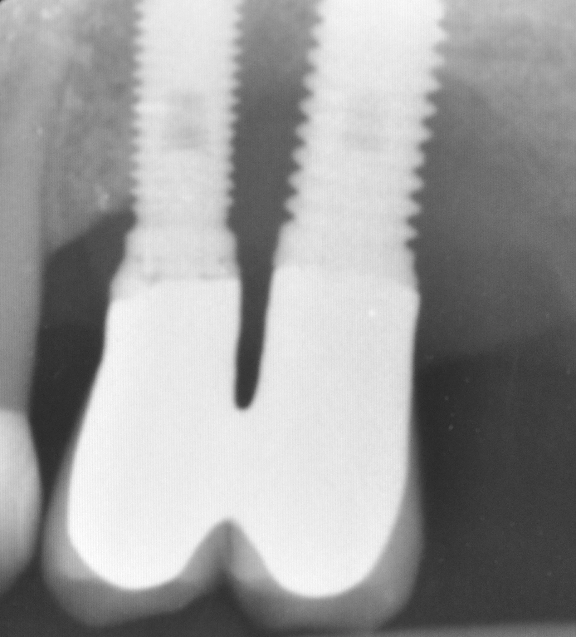 Abb. 13: Ausgangssituation: Im Röntgenbild zeigt sich ein schwerer periimplantärer krestaler Knochenverlust.