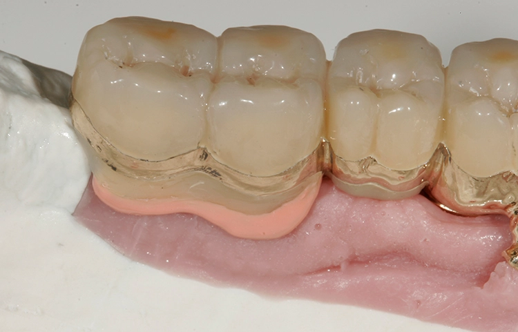 Abb. 135: Implantatschürze rosa opakert.