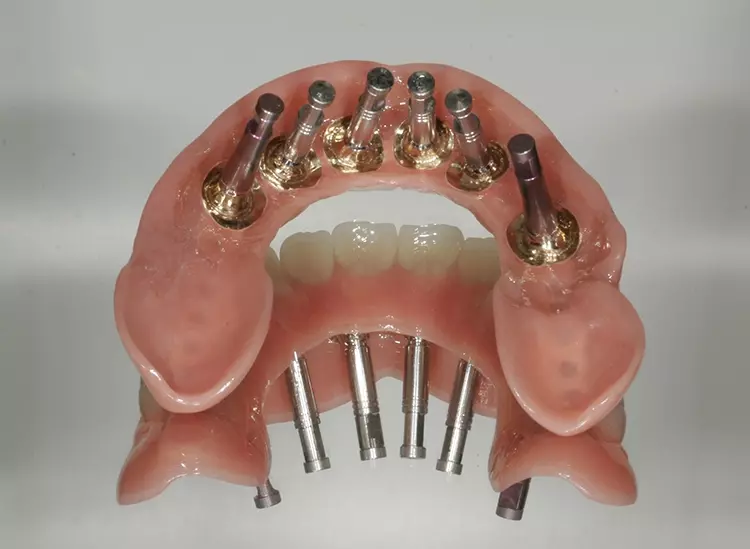 Abb. 136: Spaltfreier Sitz der Abutments.