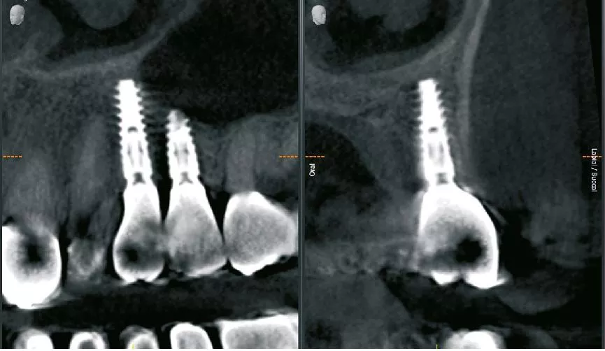 Abb. 13: Die radiologische Situation nach sechs Monaten (Implantatposition 24).