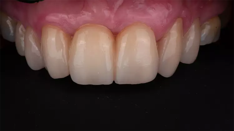 Abb. 13: Stabiles und ästhetisch ansprechendes Behandlungsergebnis.