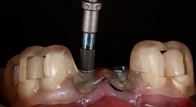 Abb. 13: Implantatinsertion durch die gleiche Schablone.