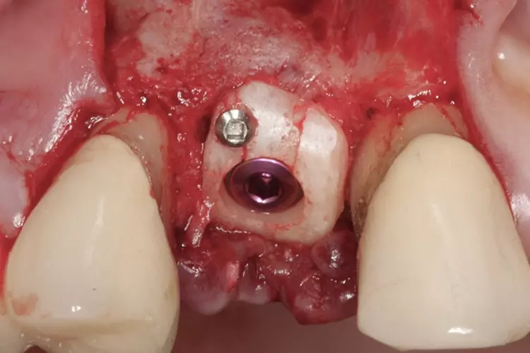 Abb. 12: Das Implantat wird subkrestal inseriert, und die Deckschraube kann
platziert werden. Es kam in diesem Fall nur eine okklusale Schraube zum Einsatz.
