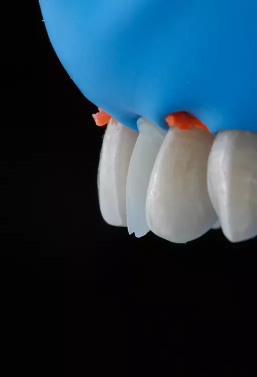 Abb. 13: Vorbereitung für die Schichtung des Komposit-Veneers unter absoluter Trockenlegung mit
Kofferdam.