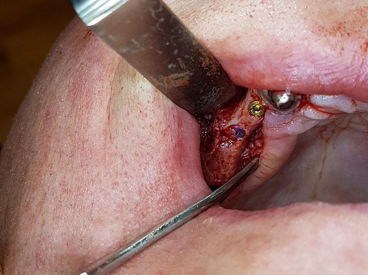 Abb. 13: Darstellung der Implantatsitus in regiones 17, 15 bis 14, 12, 22 und 25 bis 27 mit knöchernen Defekten im bukkalen und frontalen Bereich.