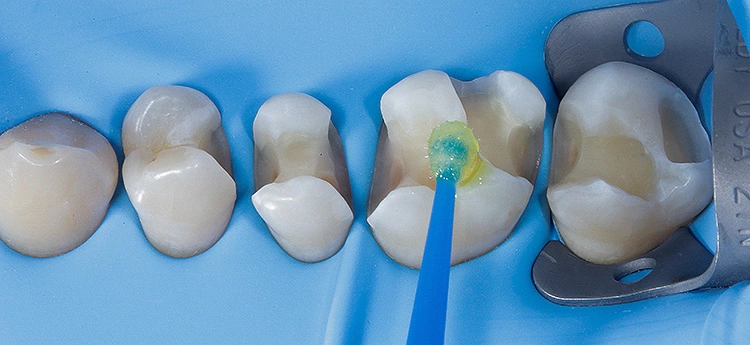 Abb. 13: Durchführung des Adhäsivschrittes und 20 Sek. einmassieren auf Schmelz und Dentin, Zähne 14–17.