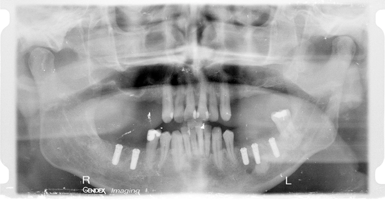 Abb. 13: Röntgenkontrollaufnahme nach Implantation mit eingedrehten Deckschrauben.